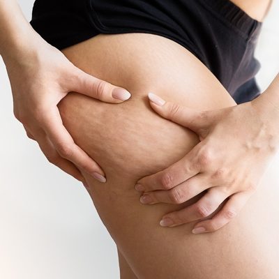 tecnico-especialista-grasa-celulitis-adelgazante