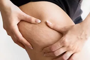 curso-online-masaje-anticelulitis-piernas